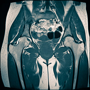 мрт томография тазобердренного сустава
