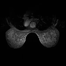 томография груди молочных желез